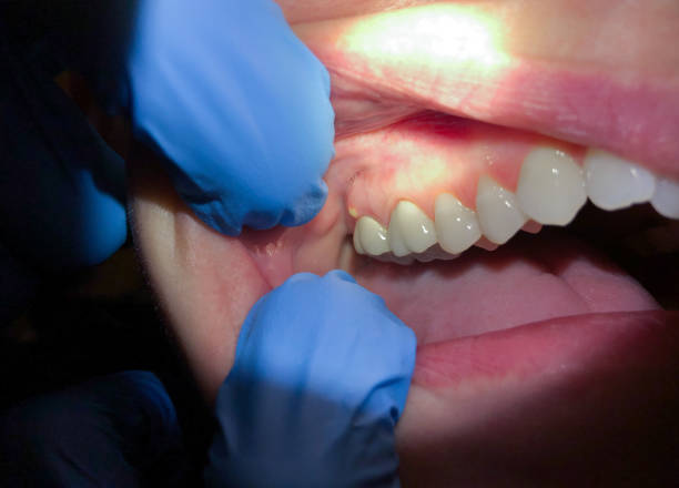 Best Emergency Tooth Extraction in Chinchilla, PA