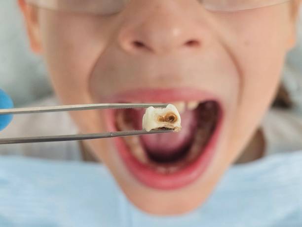 Best Emergency Treatment for Dental Infections or Abscesses in Chinchilla, PA
